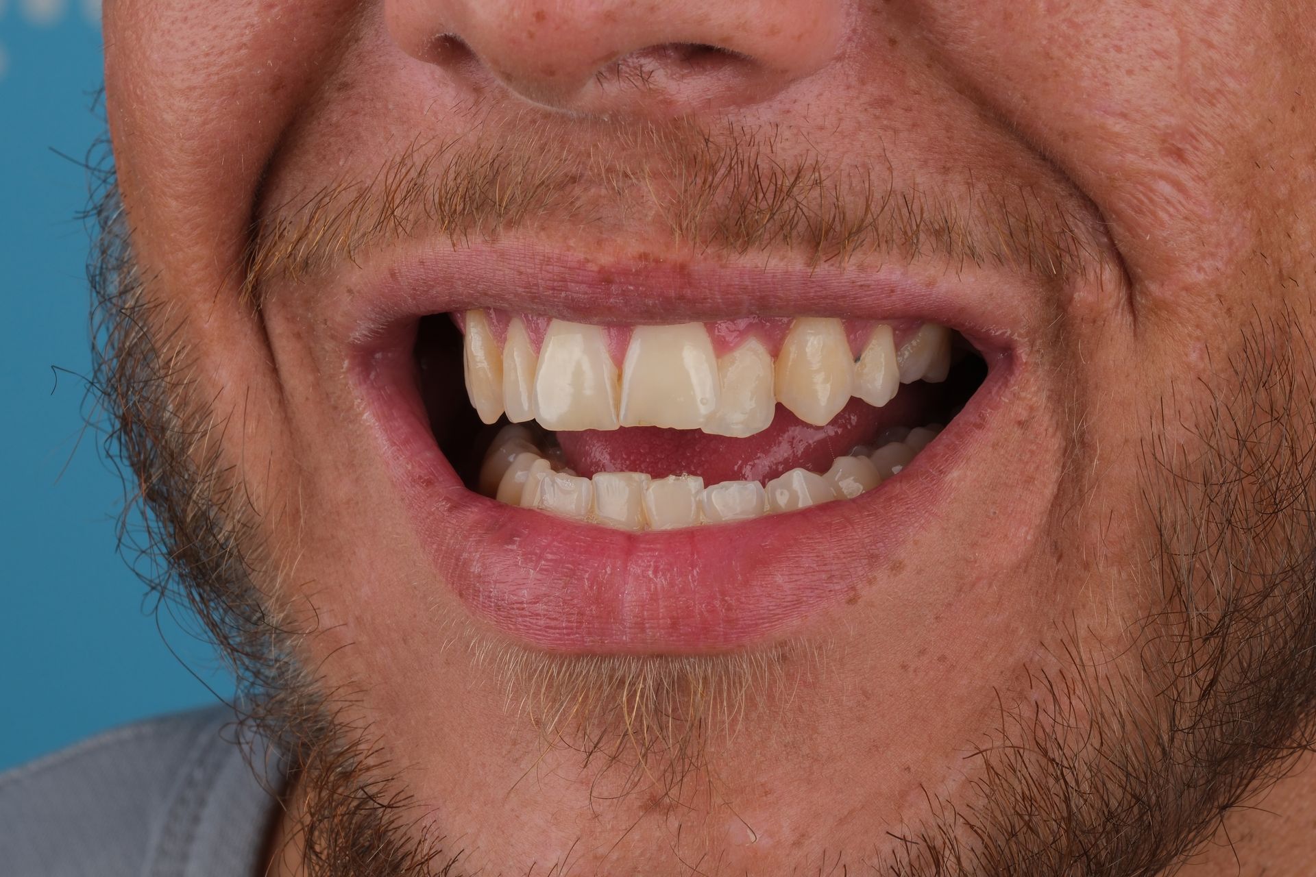 Man smiling, showing teeth, tan skin, open mouth, visible gums and tongue, with beard.