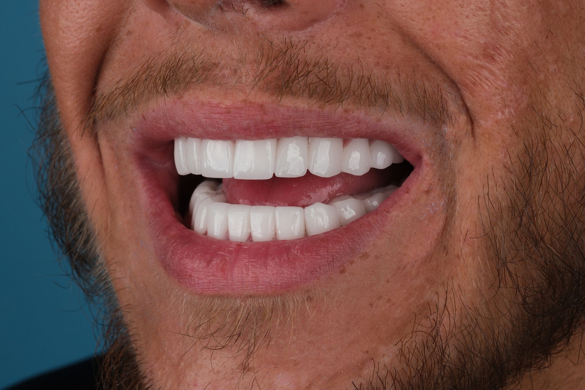 Close-up of a man's smiling mouth, revealing bright white teeth. The man has a beard and is smiling.
