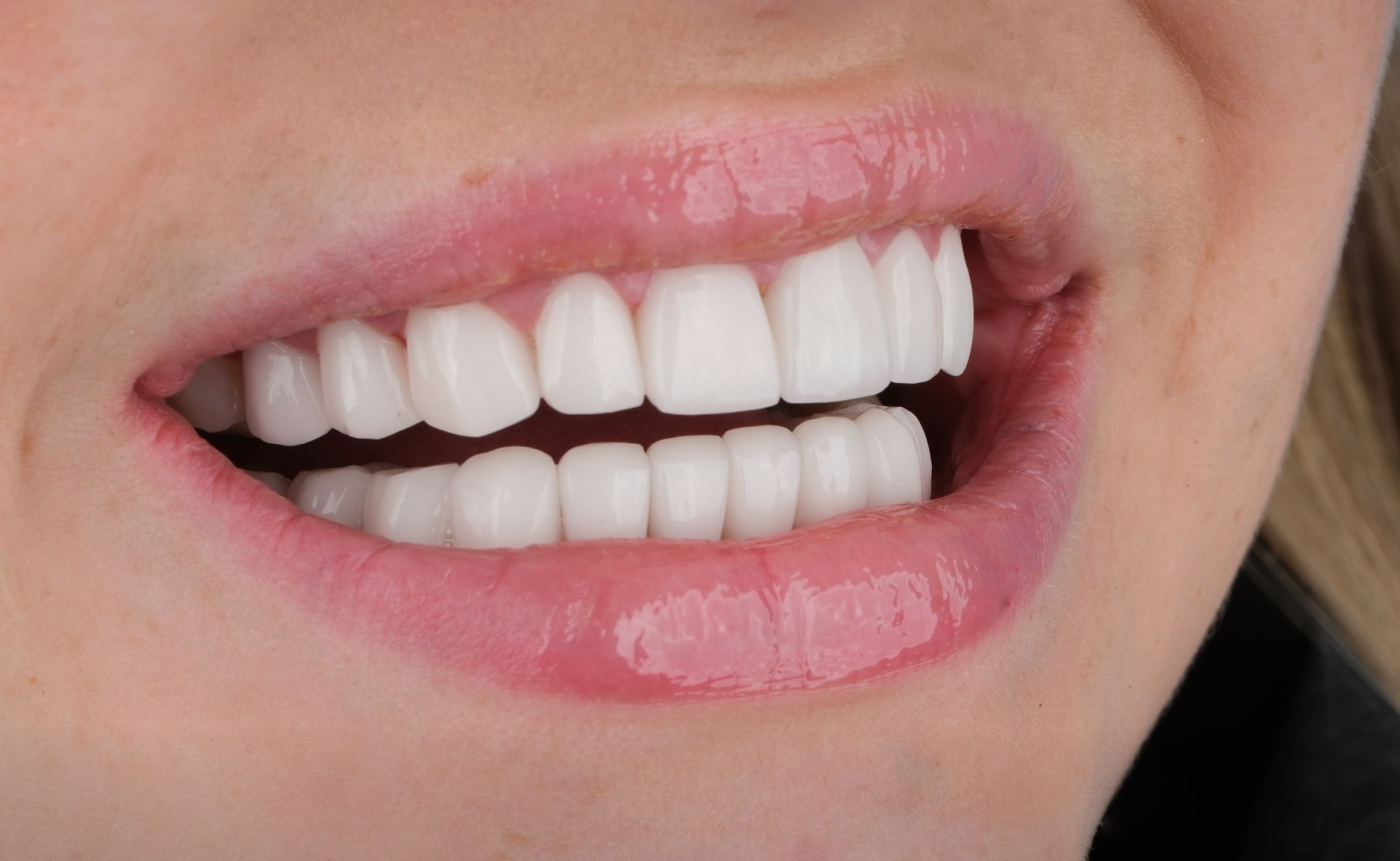 Close-up of smiling person showing very white, perfectly aligned teeth. The lips are glossy and pink.
