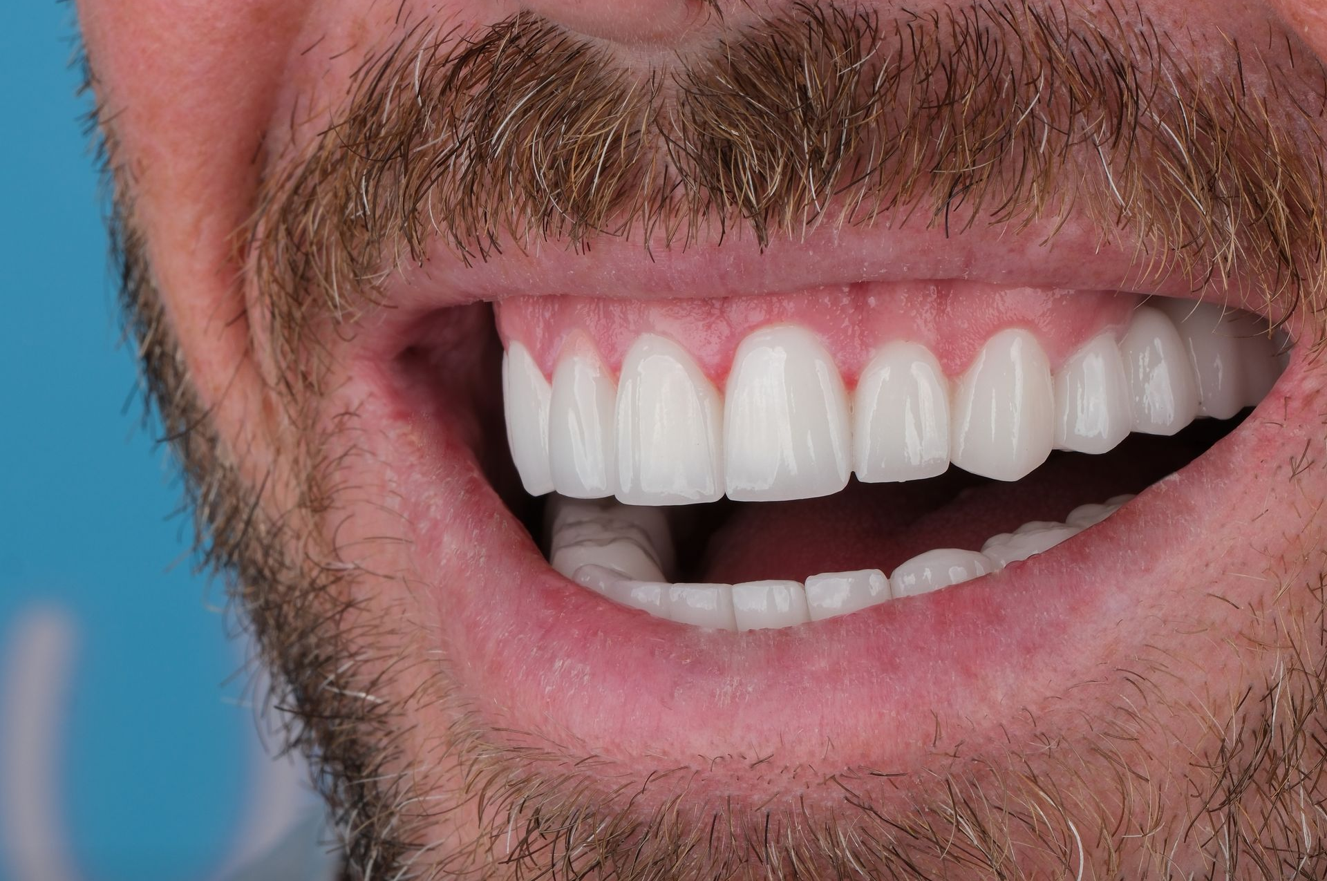 Close-up of a smiling man, showing bright white, even teeth. Brown beard and pink gums visible.