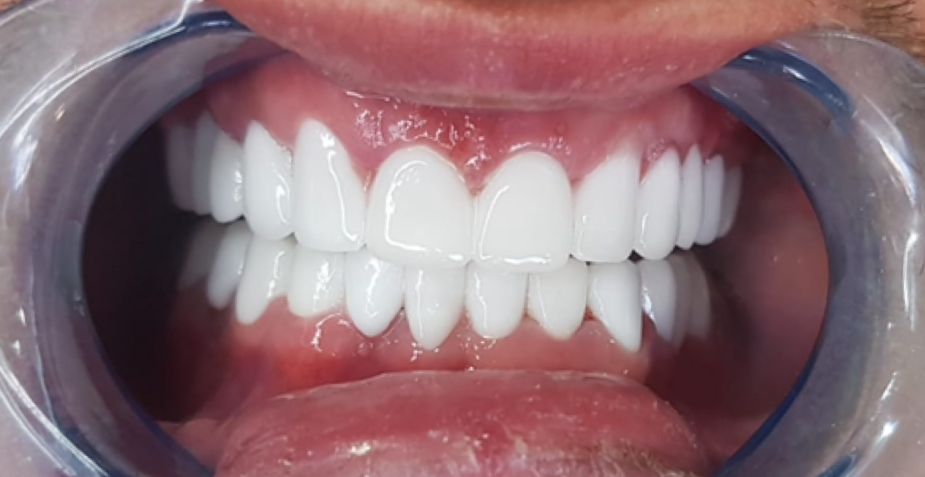 Close-up view of a mouth with perfectly white, evenly spaced teeth, held open by a dental retractor.