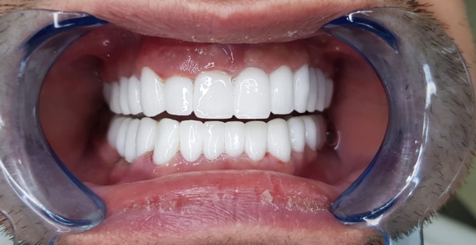 Mouth with perfect, bright white teeth, held open by a dental retractor.