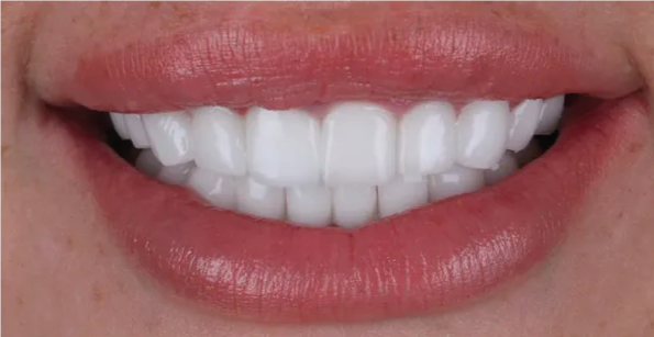 Close-up of a woman's smile, showing bright white teeth and red, glossy lips.