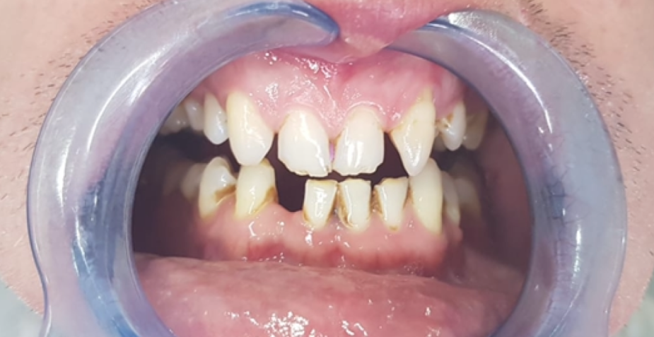 Mouth open with teeth visible, showing decay and discoloration; dental retractor in place.