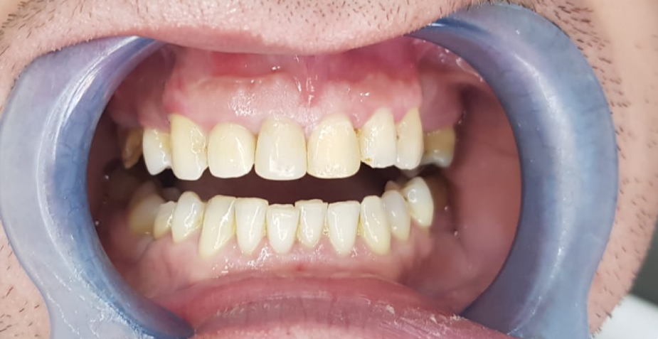 Mouth with teeth in dental exam; a retractor holds the mouth open, showing yellowed teeth.
