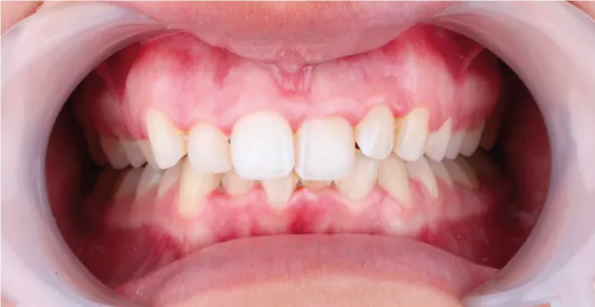 Open view of teeth inside a mouth, with gums and lips visible.