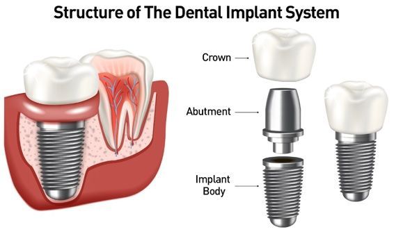 Diagram of a dental implant: implant screw in jaw with abutment and crown replacing a missing tooth.