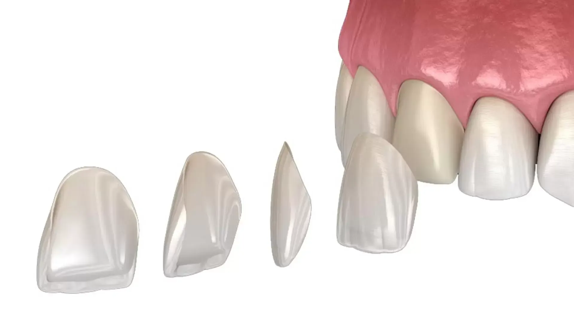 Dental veneers, thin shells, are being applied to teeth for cosmetic improvement.