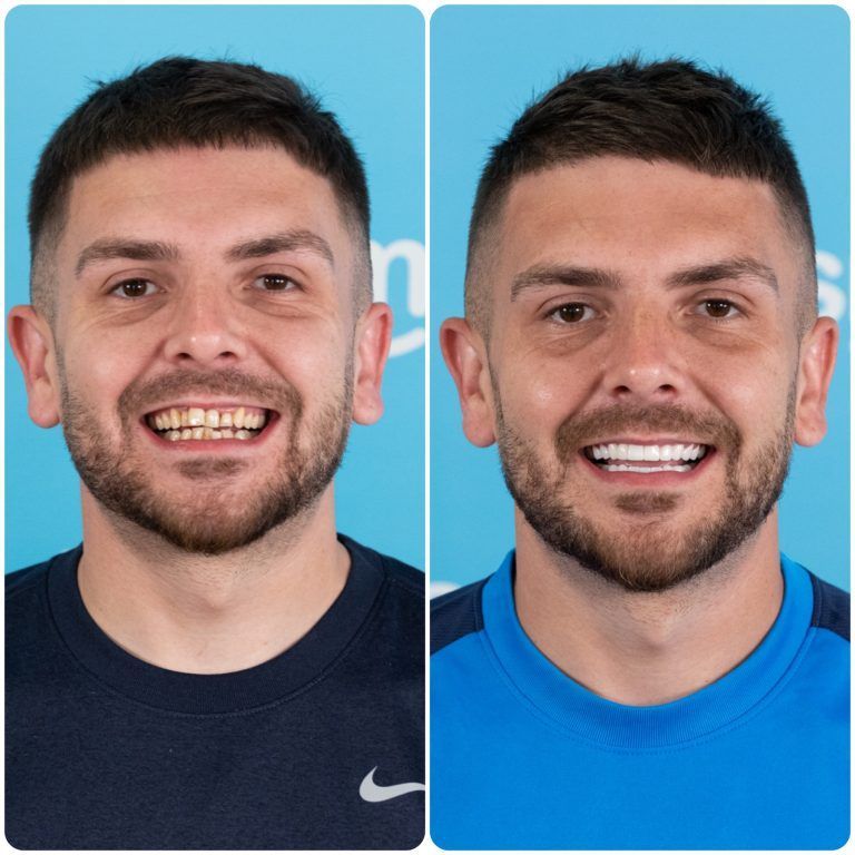 Side-by-side portraits of a man with discolored teeth (left) and bright white teeth (right); both smiling.