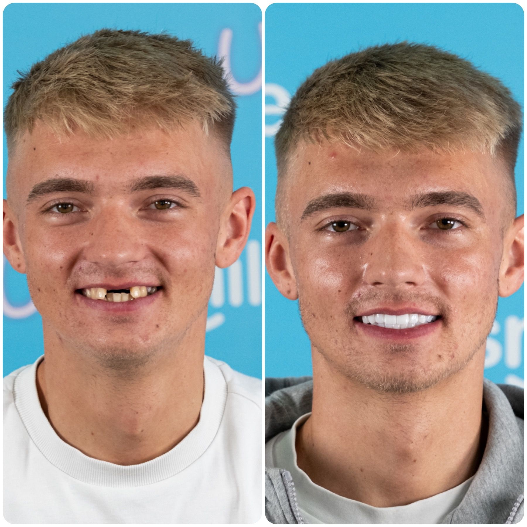 Before and after photo of a man's teeth. Left image shows missing teeth; right shows a bright, full smile.