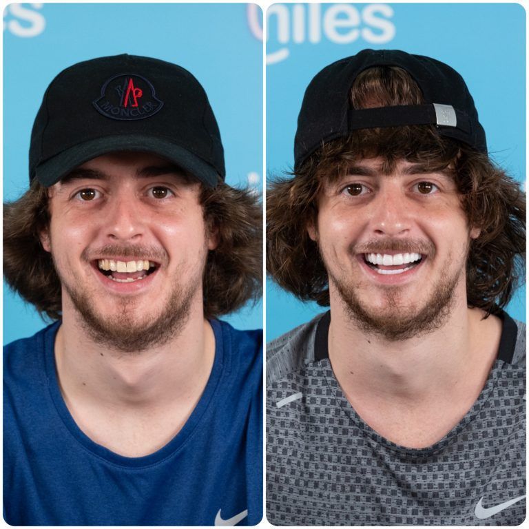 Before and after photo: Smiling man with dark curly hair and a baseball cap, improved teeth in the right photo.