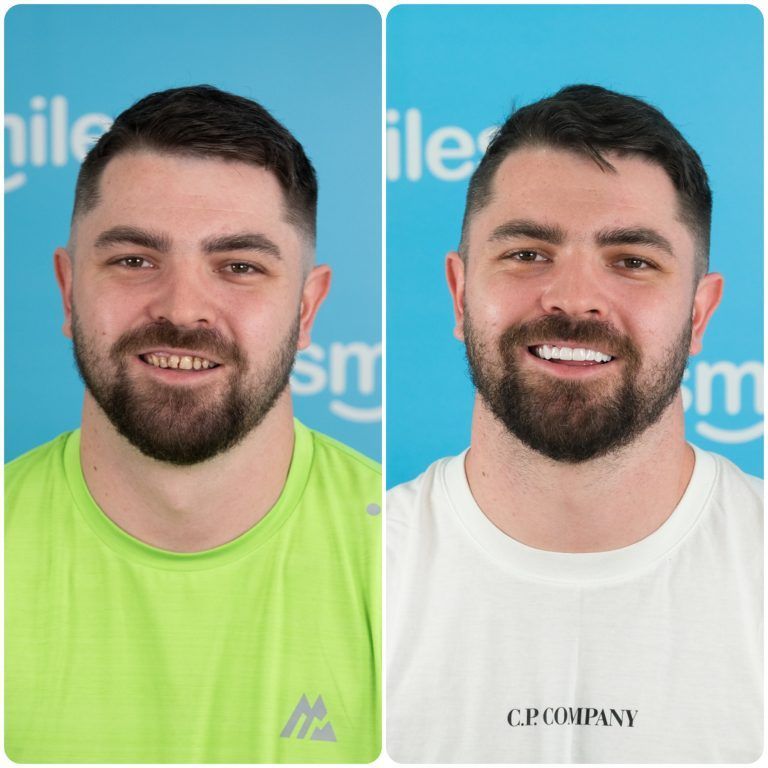 Side-by-side comparison of a man's teeth before and after dental work, revealing a brighter, straighter smile.