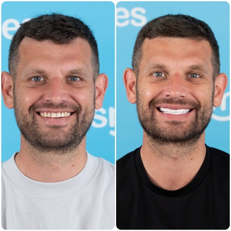 Side-by-side comparison of a man before and after teeth whitening, smiling against a blue background.