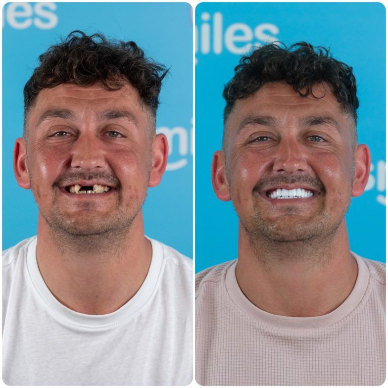 Before-and-after: man with missing teeth transforms with new, bright white smile. Blue backdrop.
