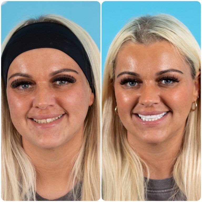 Before-and-after headshot: woman with blonde hair and dark eyes smiling, with improved teeth and skin tone.