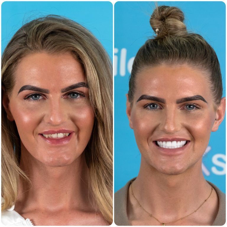 Before and after photos of a smiling person with an improved smile, showing dental work.