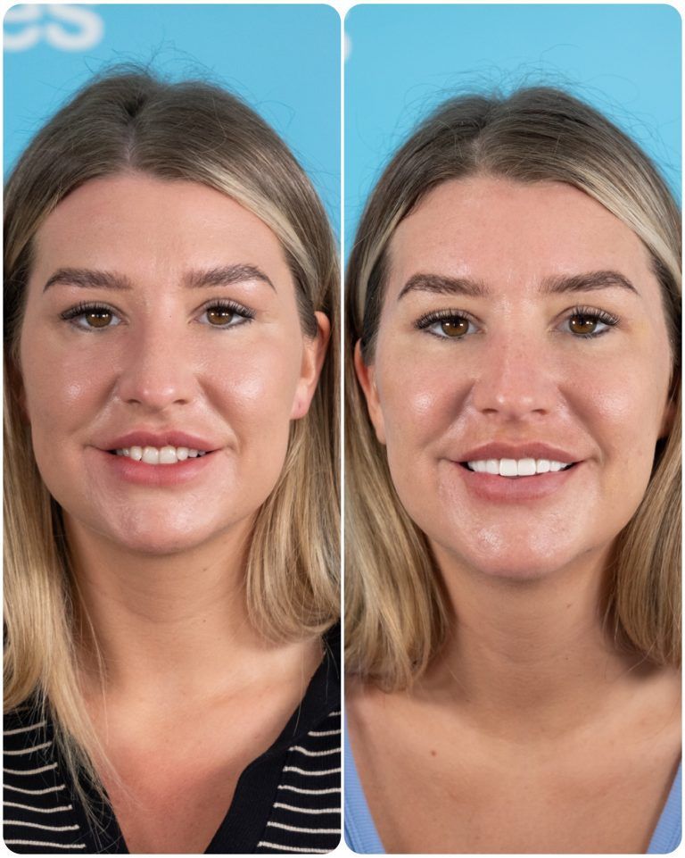 Side-by-side photos: woman before and after teeth whitening. Smiling, blonde hair, fair skin.