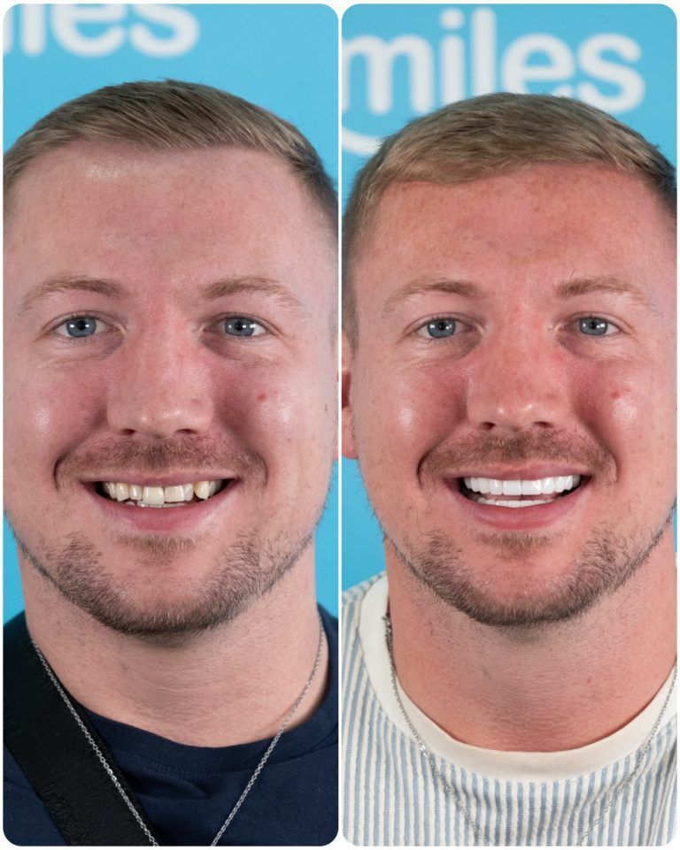 Before and after photos of a man's smile; teeth appear whiter, straighter in the after photo.