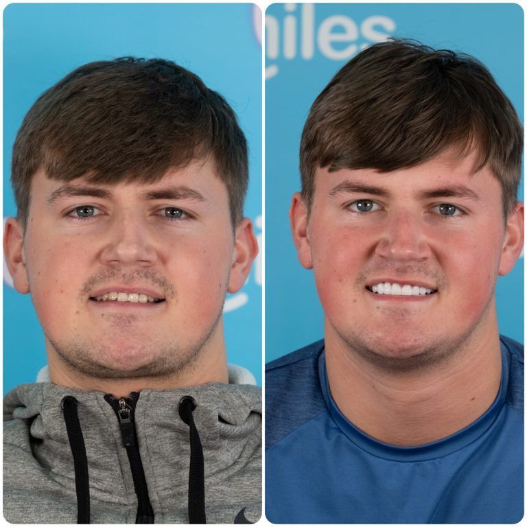 Before and after photos of a man with a brighter smile; wearing gray hoodie then blue shirt.