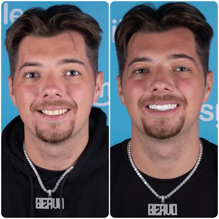 Man with slightly crooked teeth smiling (left), and smiling with new white teeth (right).