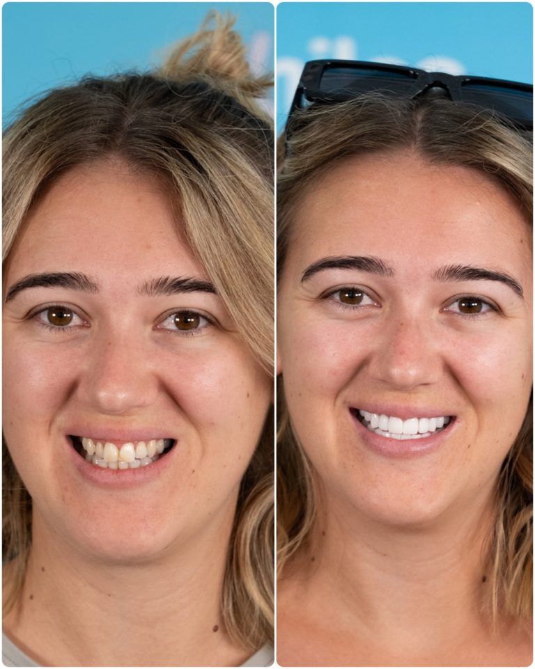 Side-by-side comparison of a woman's teeth before and after a dental procedure, smiling in both photos.