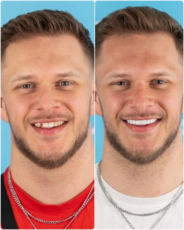 Before and after photos of a man smiling, showing improvement in his teeth.