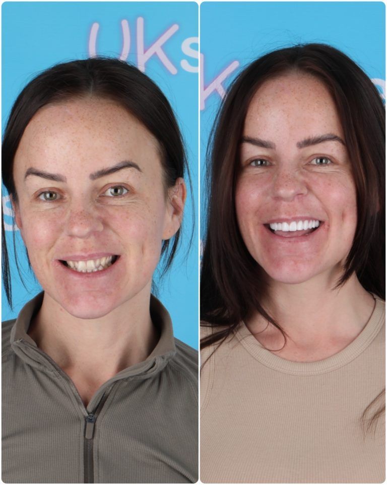 Before and after photos of a woman's teeth, smiling after cosmetic dental work, tan shirt.