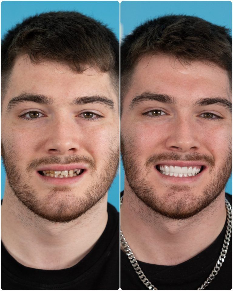 Side-by-side comparison of a man before and after a dental procedure, showing dramatically improved teeth and smile.