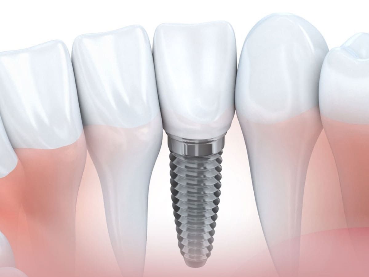 Dental implant illustration: a metal screw embedded in the jawbone with a white crown replacing a missing tooth.