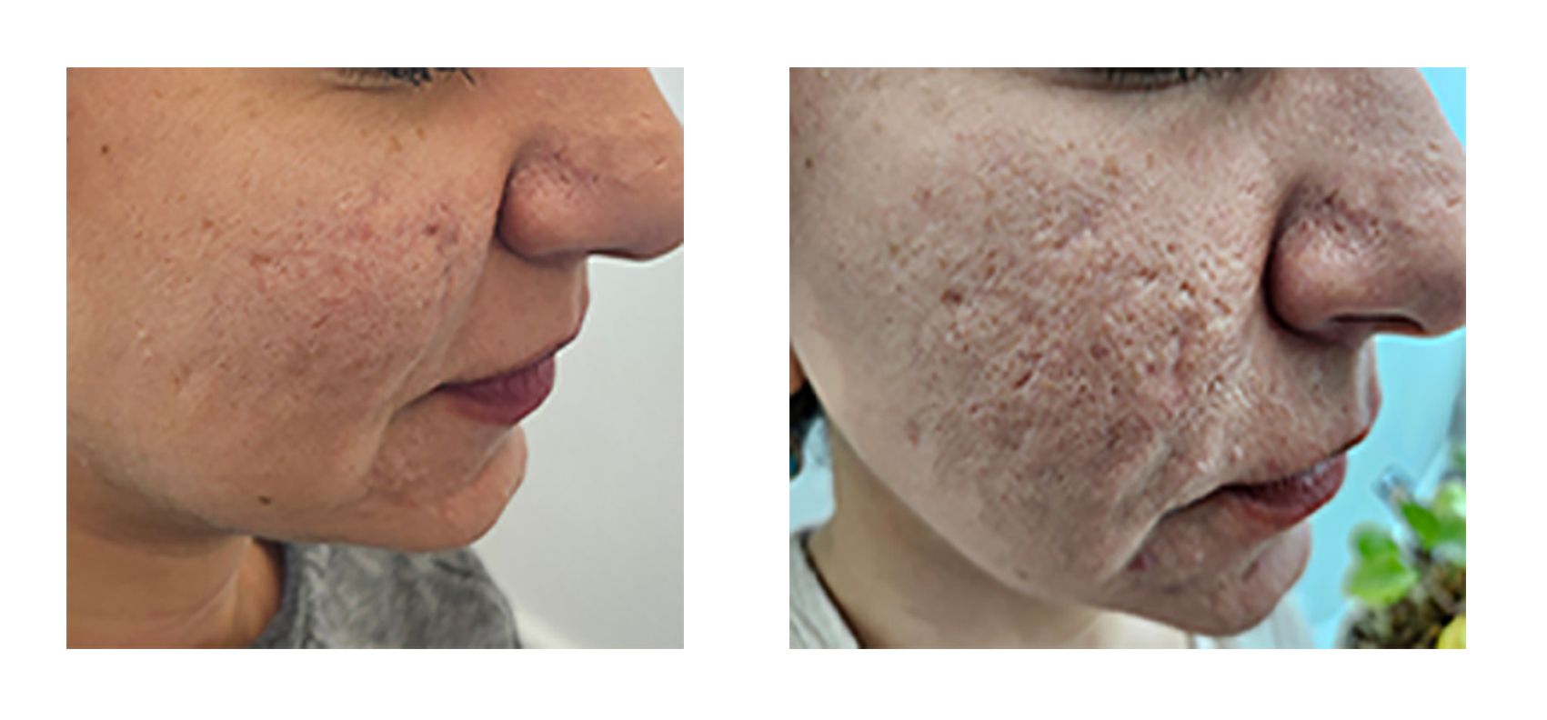 Acne Scars