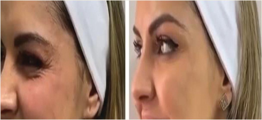 A before and after picture of a woman 's face.