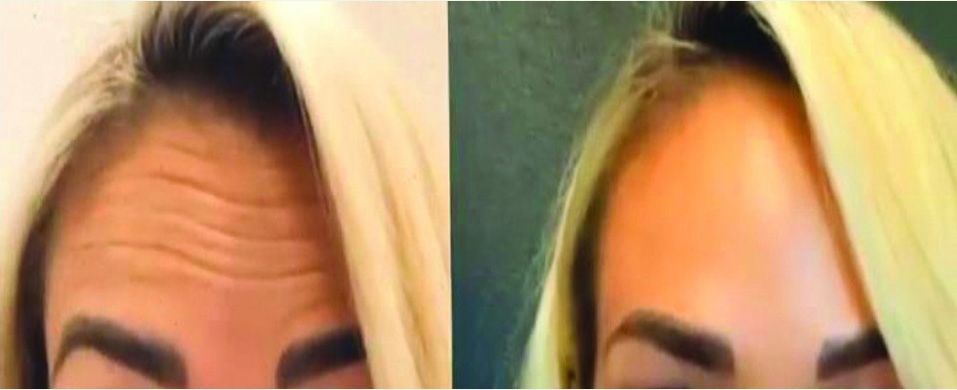 A before and after photo of a woman 's forehead.