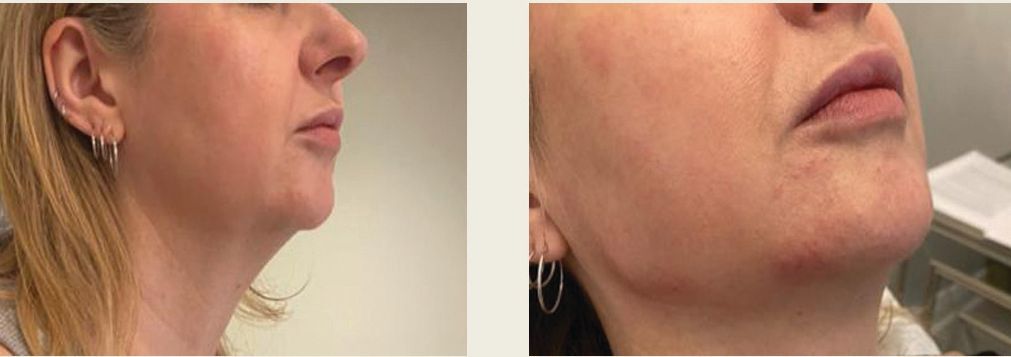 A before and after photo of a woman 's neck and face.