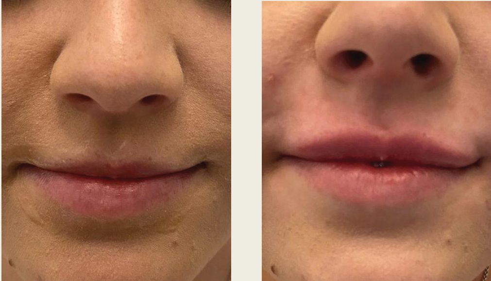 A before and after photo of a woman 's lips.