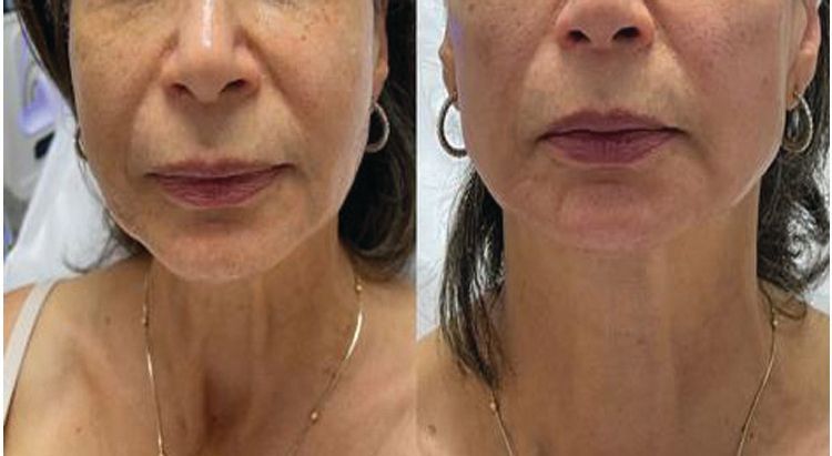 A before and after photo of a woman 's face and neck.