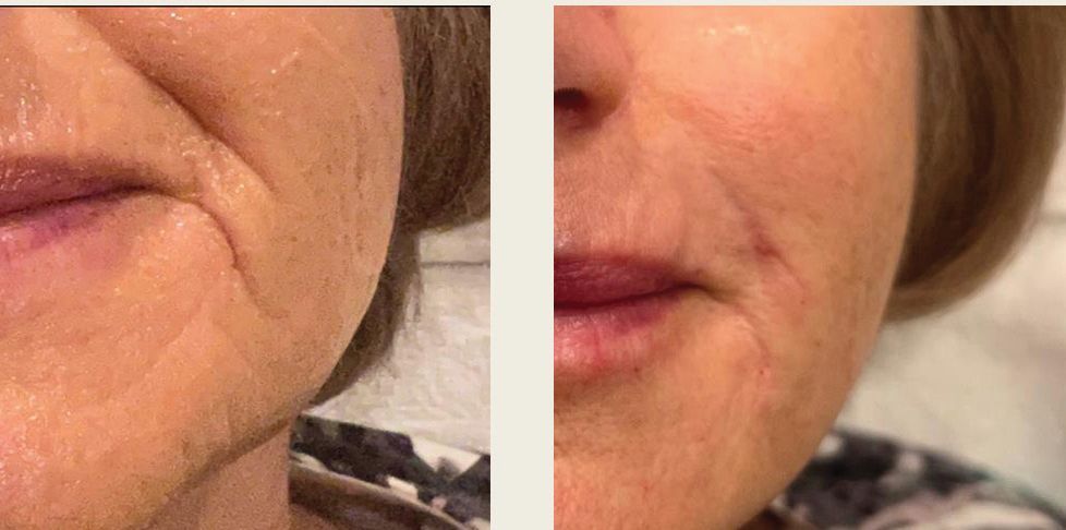 A before and after photo of a woman 's face with wrinkles.