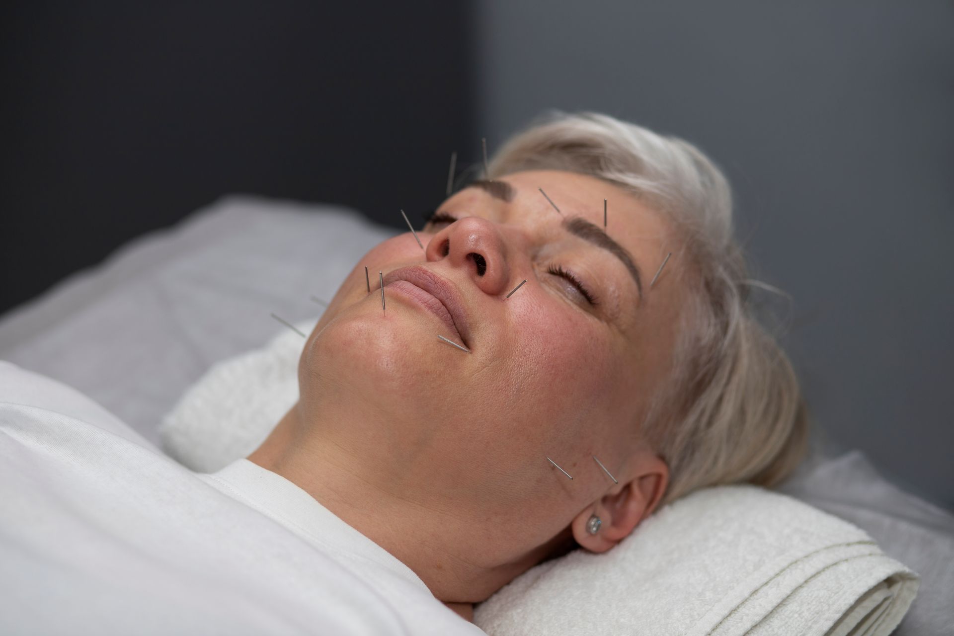 a woman is laying on a bed with acupuncture needles in her face .