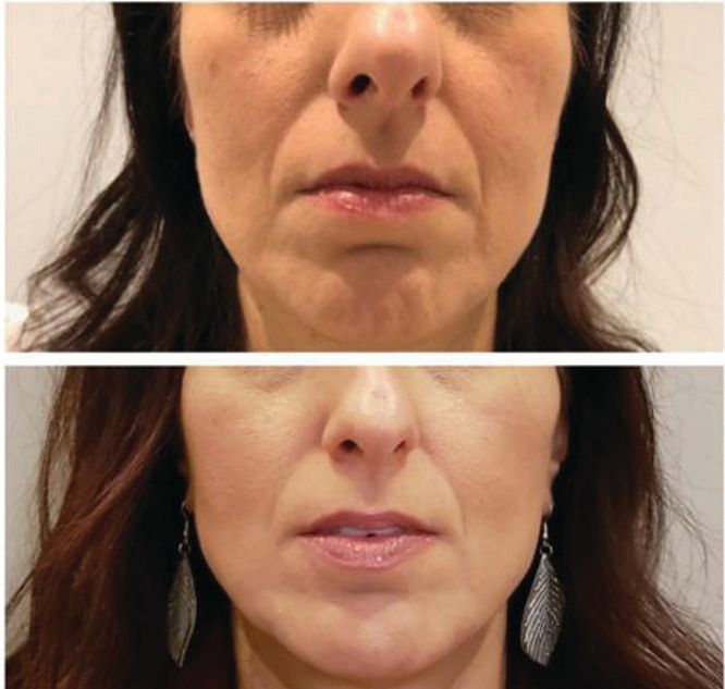 A before and after photo of a woman 's face