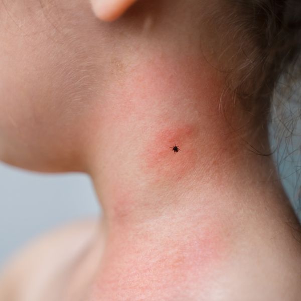 A child with a tick bite on the neck. Lyme's Disease Energy Healing - Holistic Energy Bodyworks