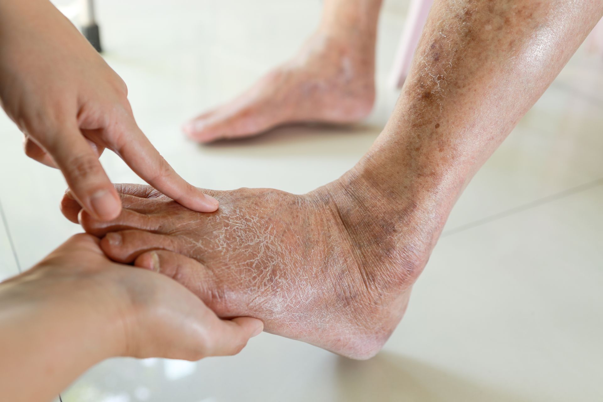 A medical professional examines a foot with dry, scaly skin and discoloration, indicating chronic venous insufficiency.