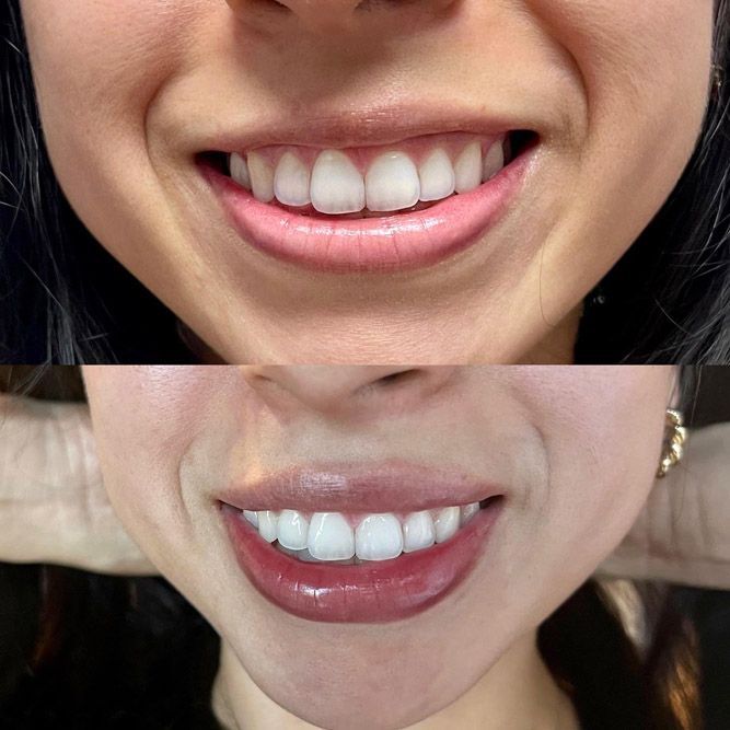 Top: Smiling mouth with natural teeth. Bottom: Smiling mouth, lipstick, and whiter teeth.