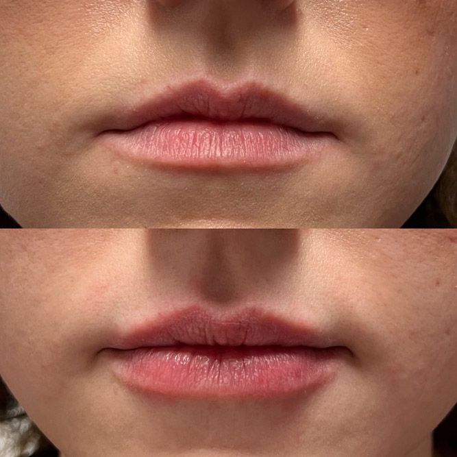 Before and after comparison of lips. Top shows thin lips, bottom shows fuller lips.