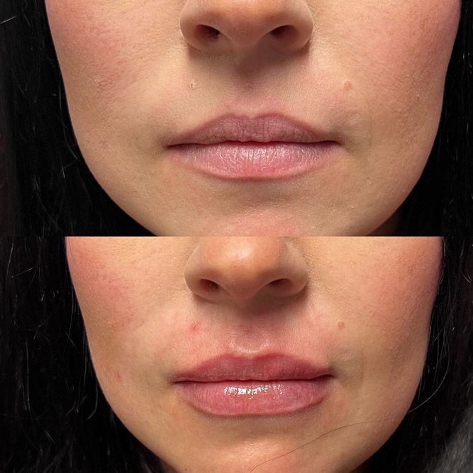 Comparison of lips before and after filler; top lips are thinner, bottom lips are fuller and glossier.