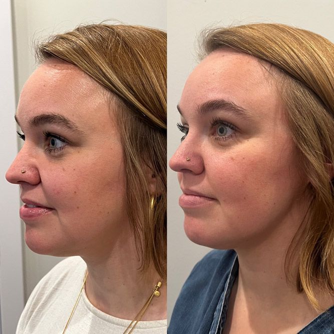 Side-by-side comparison of a person's profile. Left shows a before, right shows an after with fuller cheeks.
