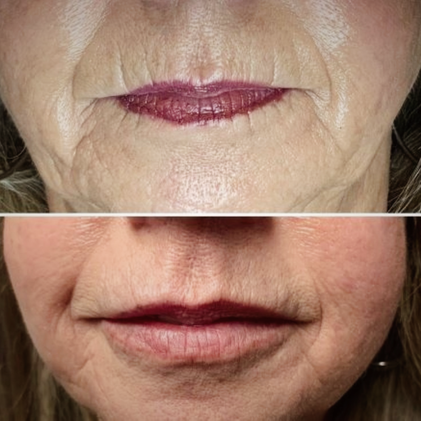 Lip and perioral filler before after Layton UT