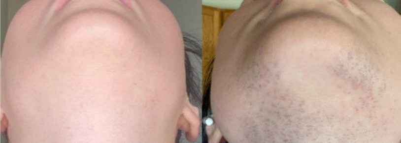 Laser hair removal for PCOS