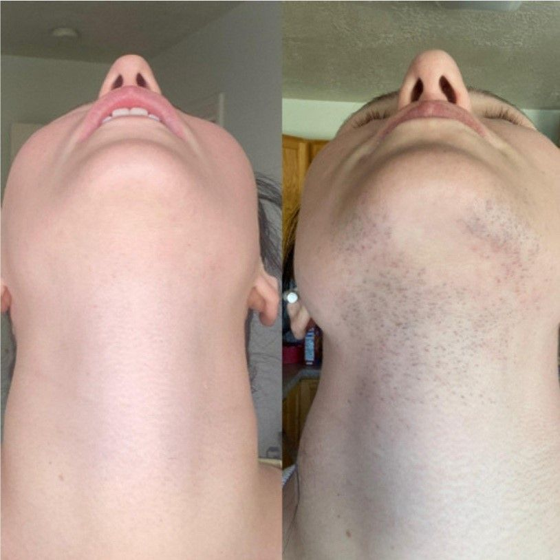 Laser Hair Removal PCOS