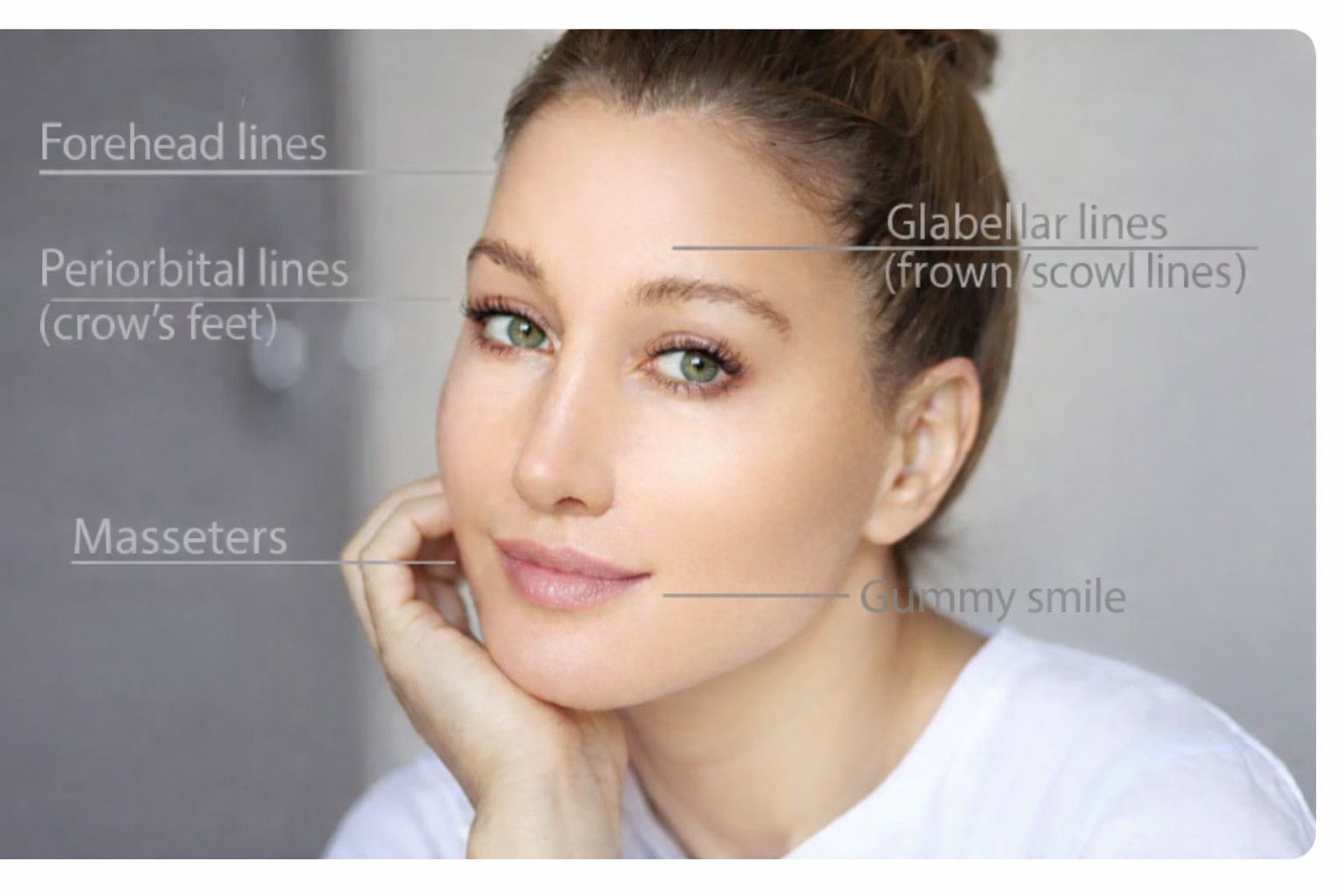 Facial diagram showing Botox treatment areas for forehead lines, crow's feet, and frown lines at ReJuvU Beauty Haven.