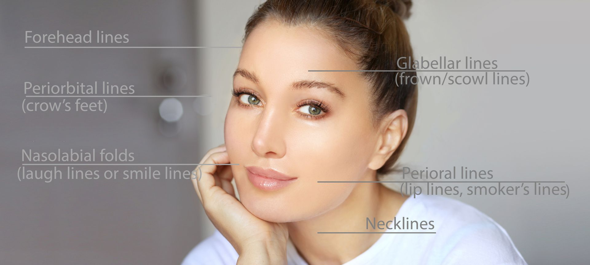 Botox injection placement areas including forehead lines, glabellar lines, crow’s feet, perioral lines and necklines