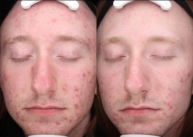 Before and after of a person's face with acne, showing a clear improvement after treatment.